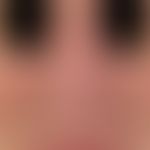 Rhinophym. diffuse shape disorder of the nose due to diffuse, partly flat, partly bumpy phym form...