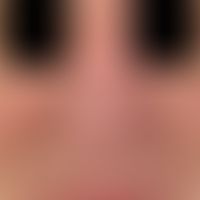 Rhinophym. diffuse shape disorder of the nose due to diffuse, partly flat, partly bumpy phym form...