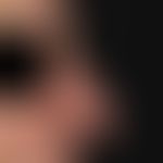Diffuse rhinophyma: massive shape disorder of the nose with localized bulbous-lobed phymogenesis

