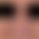Diffuse rhinophyma: massive bulbous shape disorder of the nose due to diffuse phymogenesis.
