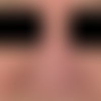 Diffuse rhinophyma: massive bulbous shape disorder of the nose due to diffuse phymogenesis.
