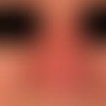 Rhinophyma (postoperative): 1 month after surgery.
