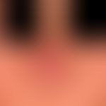 Circumscribed rhinophyma: localized phymogenesis of the nose in moderately severe rosacea. Chroni...