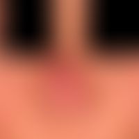 Circumscribed rhinophyma: localized phymogenesis of the nose in moderately severe rosacea. Chroni...