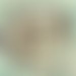 Rhinosporidiose. Reife Sphaerula mit zahlreichen Sporen bei Rhinosporidium seeberi; Nasenpolyp; G...