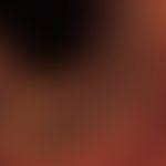 Rhinosporidiose. Reife Sphaerule mit zahlreichen Sporen; Nasenpolyp; Fungiqual A u. B Fluoreszenz...