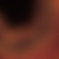 Rhinosporidiose. Reife Sphaerule mit zahlreichen Sporen; Nasenpolyp; Fungiqual A u. B Fluoreszenz...
