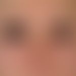 Rubella. 5-day-old female patient with occipital and nuchal lymph node swelling and slight temper...