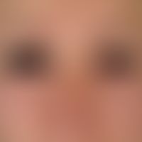 Rubella. 5-day-old female patient with occipital and nuchal lymph node swelling and slight temper...