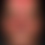 Rosazea.&nbsp;Stadium III der Rosazea mit konfluierenden, entzündlichen Granulomen (Rosacea congl...
