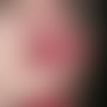 Rosazea. Stadium I- II der Rosazea (Rosacea papulopustulosa) Bei der 34-jährigen Patientin besteh...