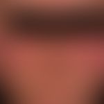 Diiferenzialdiagnose: Rosacea erythematosa, Stadium I

Diagnose: Lupus erythematodes systemischer...