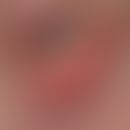 Rosazeablepharitis. Am rechten Augenunterlid befindet sich in der Wimpernreihe eine kleine Pustel...