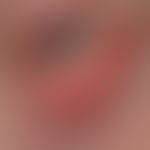 Rosazeablepharitis. Am rechten Augenunterlid befindet sich in der Wimpernreihe eine kleine Pustel...