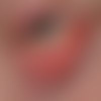 Rosacea tablepharitis. On the right lower eyelid there is a small pustule in the row of eyelashes...