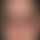 Rubeosis diabeticorum. Chronische, seit 12 Monaten persisitierende, flächige Rötungen sowie multi...