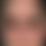 Rubeosis diabeticorum. Chronische, seit 12 Monaten persisitierende, flächige Rötungen sowie multi...