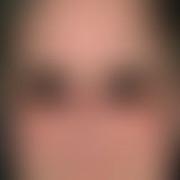 Rubeosis diabeticorum. Chronische, seit 12 Monaten persisitierende, flächige Rötungen sowie multi...