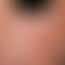 Rubeosis steroidica, flat redness of the cheeks with follicular papules in young patient.
