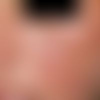 Rubeosis steroidica, flat redness of the cheeks with follicular papules in young patient.