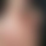Rubeosis steroidica. extensive redness with follicular papules, multiple telangiectasias in atrop...