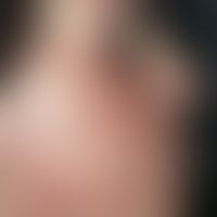 Rubeosis steroidica. extensive redness with follicular papules, multiple telangiectasias in atrop...