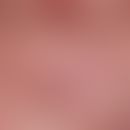Partial aspect of a Sahlischer venousring with livid red, strongly dilated, small vessels submamm...