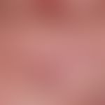 Partial aspect of a Sahlischer venousring with livid red, strongly dilated, small vessels submamm...