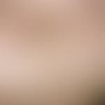 Sahlischer venous ring. Fine, red or red-blue, linear, smooth patches (vascular dilatations) in t...