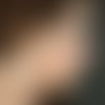Sarkoidose: kleinknotig disseminierte Sarkoidose der Haut. Lungenbeteiligung. Therapieresistenz, ...
