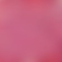 Sarcoidosis: Detail enlargement: "naked" (without lymphocytic concomitant reaction), non-cheesema...