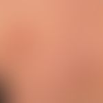 Sarkoidose Plaque-Form:&nbsp; Detailaufnahme mit den unterschiedlichen Effloreszenzentypen (Papel...