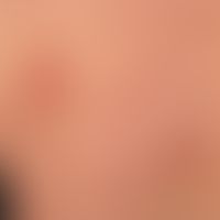 Sarcoidosis plaque form: detailed picture with the different types of efflorescence (papules, pla...