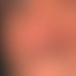 Sarkoidose der Haut: flache, symptomlose, braun-rote, gut abgrenzbare glatte Plaque an der Nasens...
