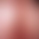 Scabies granulomatosa. Nach antiskabiöser Therapie persistierende, heftig juckende, gruppierte Pa...