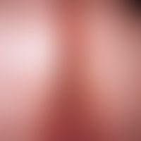 Scabies granulomatosa. Nach antiskabiöser Therapie persistierende, heftig juckende, gruppierte Pa...