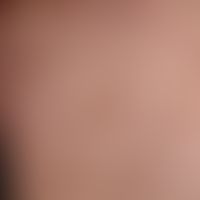 Scabies granulomatosa; after antiscabial therapy persistent, severely itching, reddish-brown, sol...