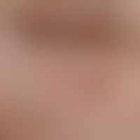 Scabies granulomatosa, detail section: Intensely itchy, reddish, solitary or grouped papules on t...