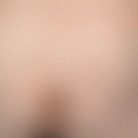 Scabies granulomatosa, highly itchy (especially at night), solitary papules and nodules on the lo...