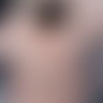 Scabies norvegica: excessive infestation with dirty-brown, keratotic changes in the area of the f...