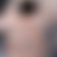 Scabies norvegica: excessive infestation with dirty-brown, keratotic changes in the area of the f...