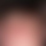 Scabies norvegica: Severe, generalized, untreated scabies of the whole integument with flat, psor...
