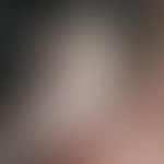 Scabies norvegica: flat, psoriasiform scaly crusts on the hairy scalp as well as broad, perilesio...