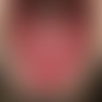 Scharlach. Rote, belagfreie Zunge mit geschwollenen Zungenpapillen (Scharlachzunge). Rötung und S...