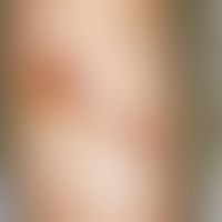 Lymphoma, cutaneous T-cell lymphoma, pleomorphic, small, medium, large-cell. 6 months old, clinic...