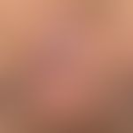 AIN: perianal lokalisierte flächige, samtartige, bräunliche Areale. Nebenbefundlich Condylomata a...