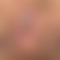 AIN: perianal lokalisierte flächige, samtartige, bräunliche Areale. Nebenbefundlich Condylomata a...