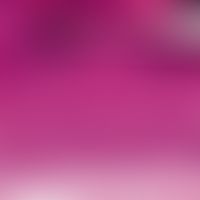 AIN. AIN I: Breites, akanthotisches Epithel mit Orthohyperkeratose. Im unteren Drittel des Epithe...
