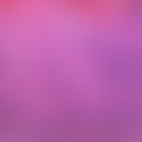AIN. AIN III: Breites, akanthotisches Epithel mit Parahyperkeratose. Über das gesamte Epithelband...