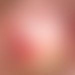 AIN. Anale Dysplasie. Großes, hyperkeratotisches Areal mit kleineren Satelliten-Läsionen. Die Obe...